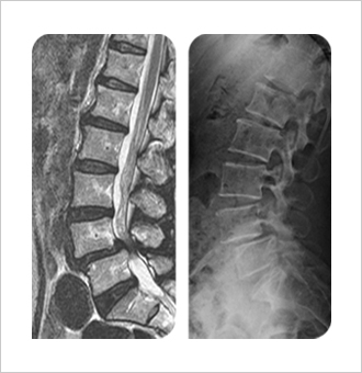 퇴행성 척추 전방 전위증 환자의 MRI 및 일반 x-ray 사진