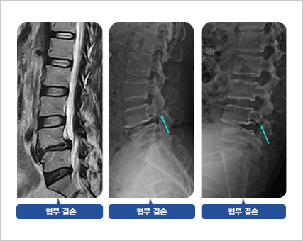 분리성 척추 전방 전위증 환자의 MRI 및 일반 x-ray 사진